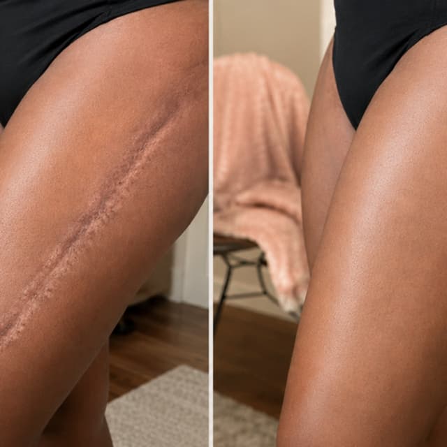 Thigh Lift Scar Camouflage at Restored Hue Paramedical Studio in Atlanta, GA