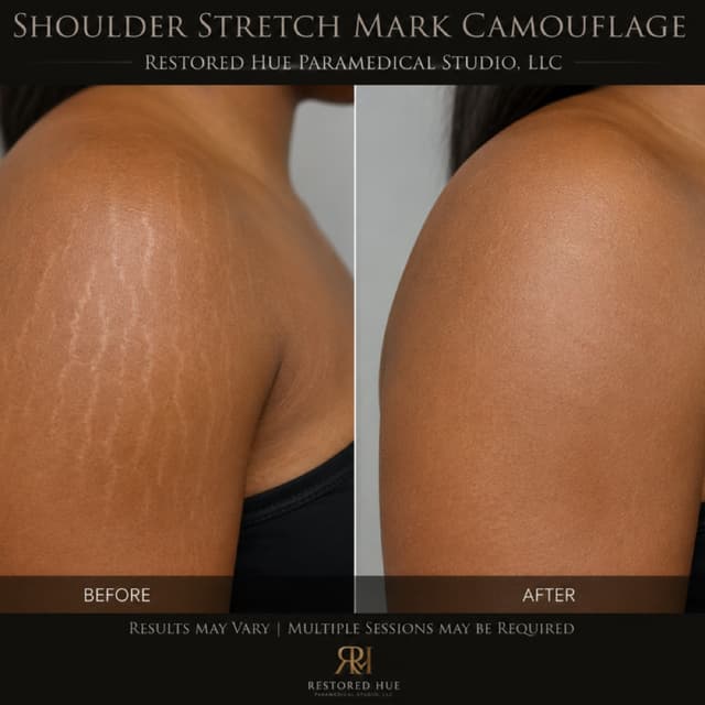 Shoulder Stretch Mark Camouflage at Restored Hue Paramedical Studio in Atlanta, GA