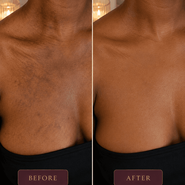 Skin Discoloration Camouflage at Restored Hue Paramedical Studio in Atlanta, GA