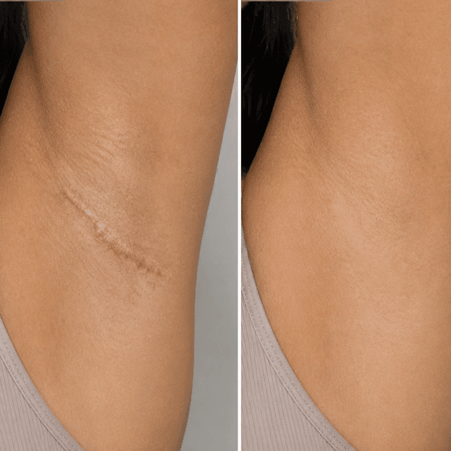 Underarm Scar Camouflage at Restored Hue Paramedical Studio in Atlanta, GA