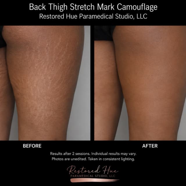 Back Thigh Stretch Mark Camouflage at Restored Hue Paramedical Studio in Atlanta, GA