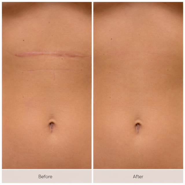 Upper Abdomen Scar Camouflage at Restored Hue Paramedical Studio in Atlanta, GA