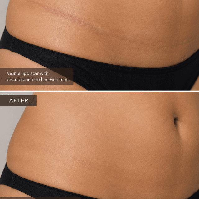 Lipo Scar Camouflage at Restored Hue Paramedical Studio in Atlanta, GA