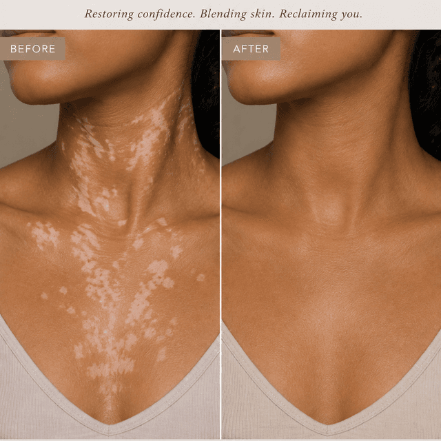 Vitiligo Package at Restored Hue Paramedical Studio in Atlanta, GA