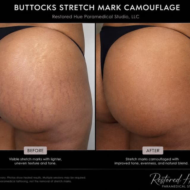 Buttocks Stretch Mark Camouflage at Restored Hue Paramedical Studio in Atlanta, GA